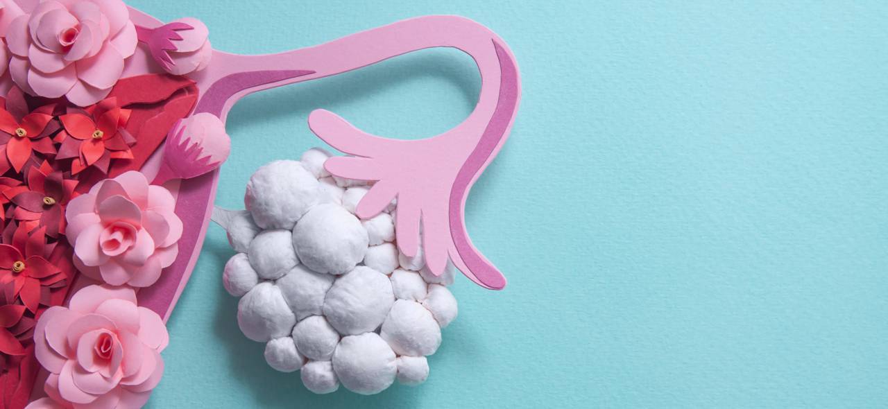 Polyzystisches Ovarialsyndrom