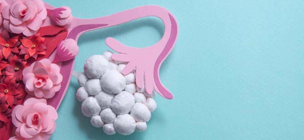 Σύνδρομο πολυκυστικών ωοθηκών (PCOS)