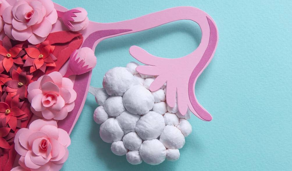 Σύνδρομο πολυκυστικών ωοθηκών (PCOS)