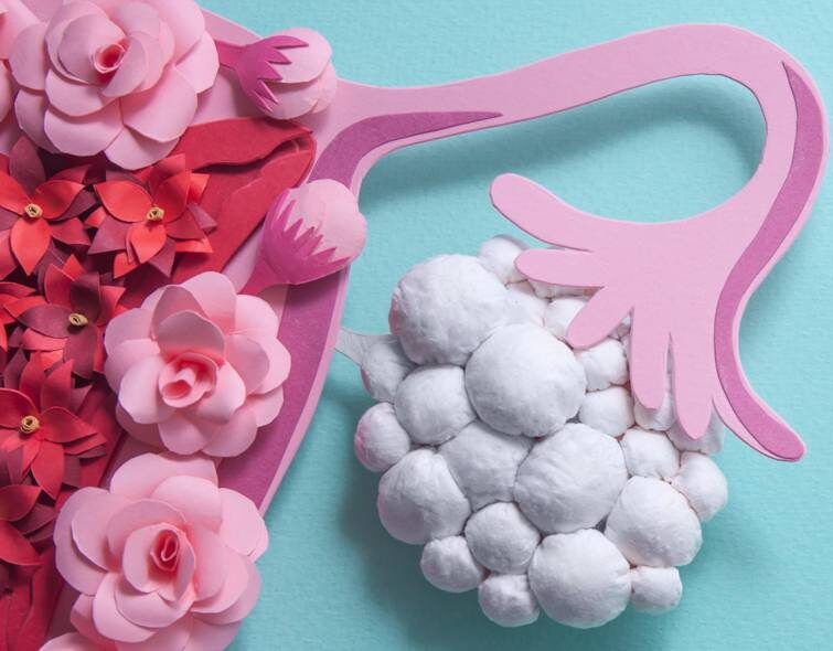 Polycystic Ovary Syndrome